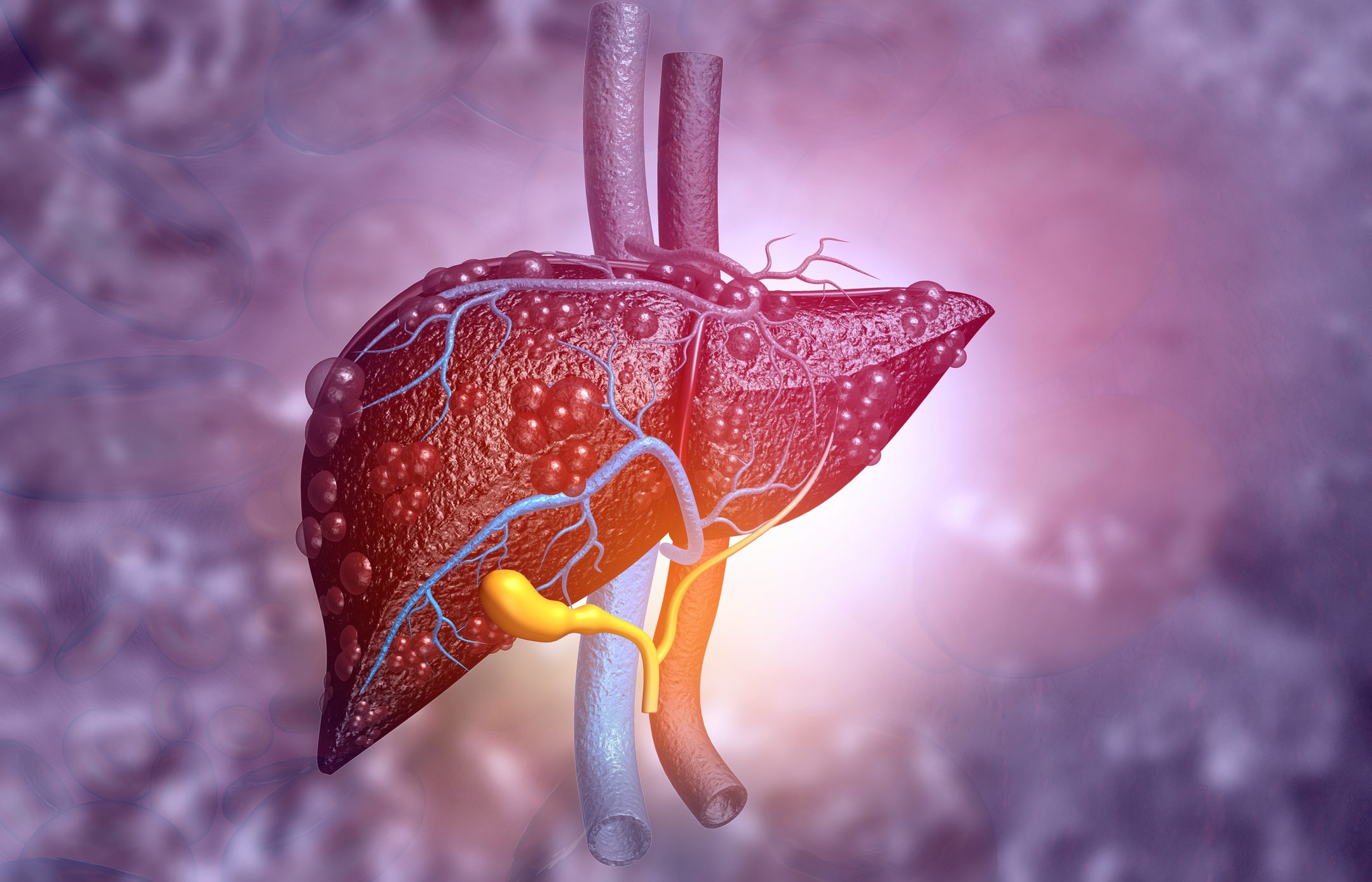 Digital 3D image of diseased liver